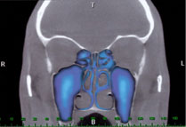 After CAT Scan shows HydroPulse® Neo results, clearing of sinuses back to normal