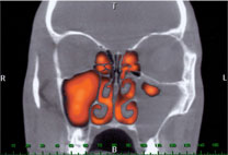 Before CAT Scan shows congested sinuses before HydroPulse® Neo treatment